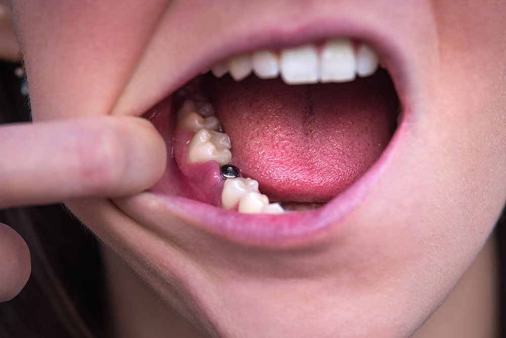 長く健康に使うために、治療後もお口を管理します
