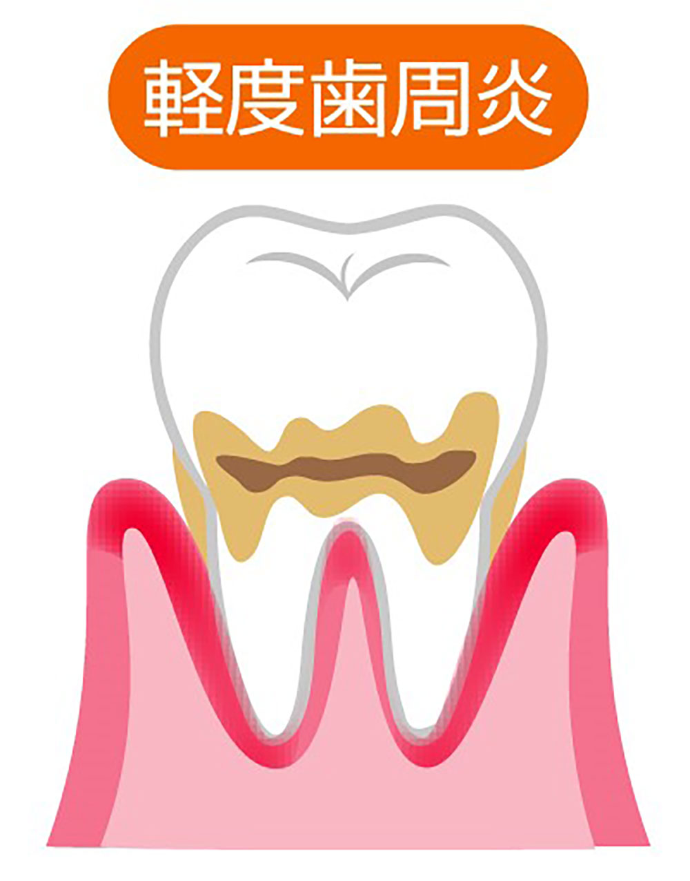軽度歯周炎