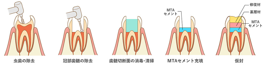生活断髄法